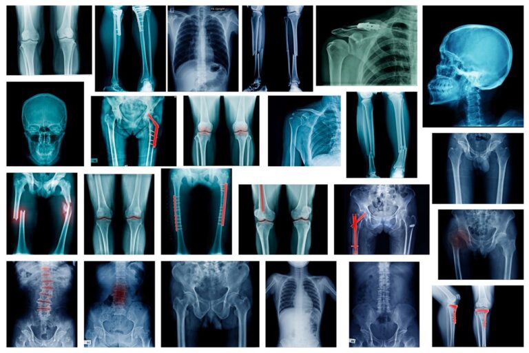 fracturas-de-huesos-ca700d42-1280x853-1
