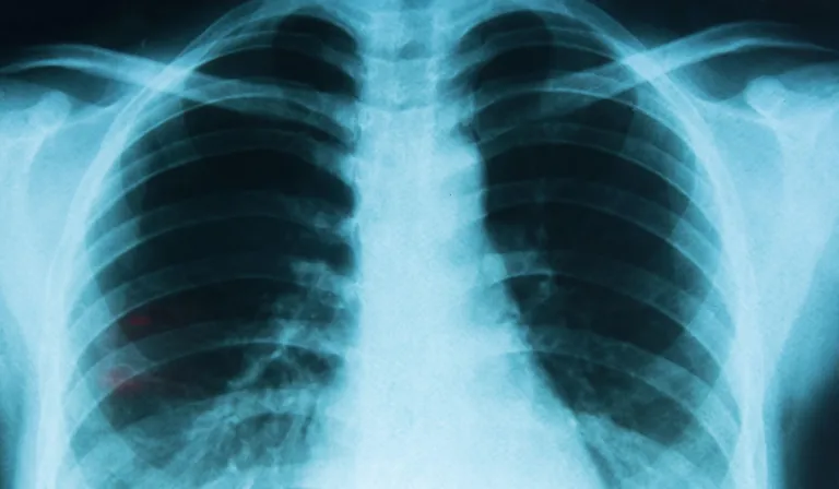 La contaminación del aire y su vínculo con los distintos tipos de cáncer de pulmón, según un nuevo estudio